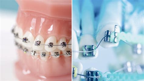 para que sirven las ligaduras metalicas en los brackets|ligaduras de unión dental.